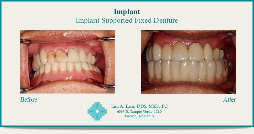 Implant Supported Fixed Denture