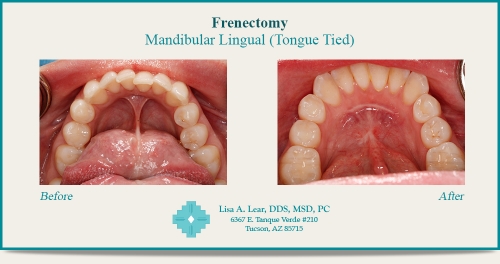 Mandibular Lingual (Tongue Tied)