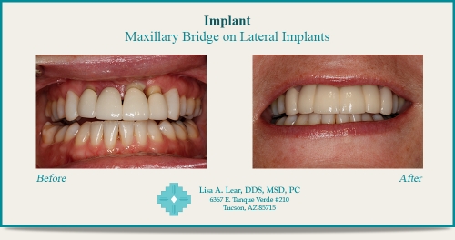 Maxillary Bridge on Lateral Implants