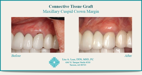Maxillary Cuspid Crown Margin