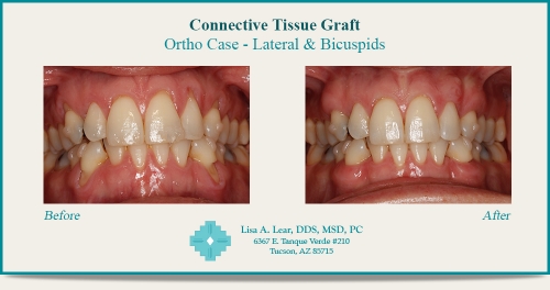 Ortho Case - Lateral & Bicuspids